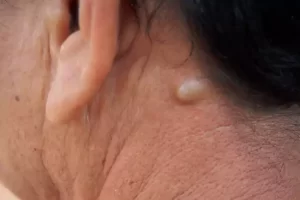 لیپوم چیست و چطور درمان می شود؟